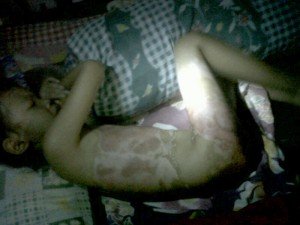 rara Rara 3 bulan menderita luka bakar Parah